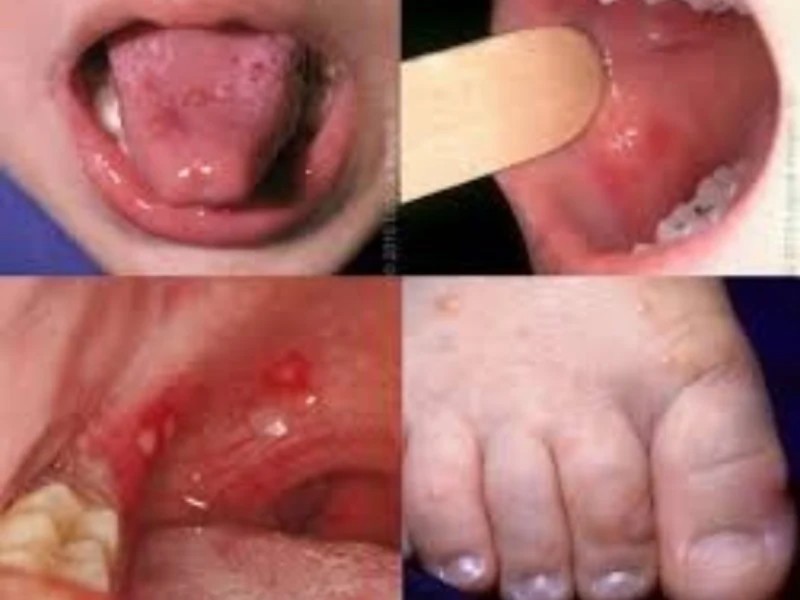 國內新增2例腸病毒感染併發重症病例 請家長及教托育機構落實腸病毒防疫措施