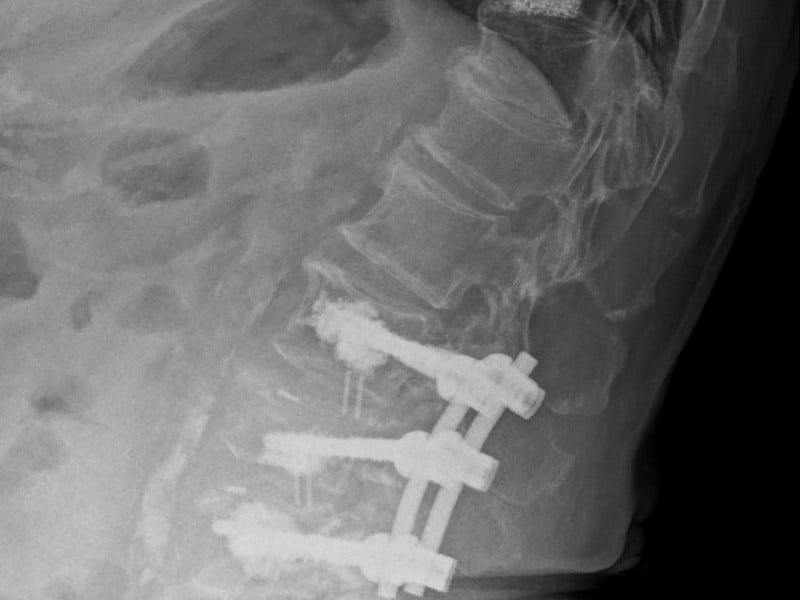 七旬婦搬衣物竟痛到下不了床　骨鬆引發脊椎壓迫性骨折 微創骨水泥手術助重拾行動力